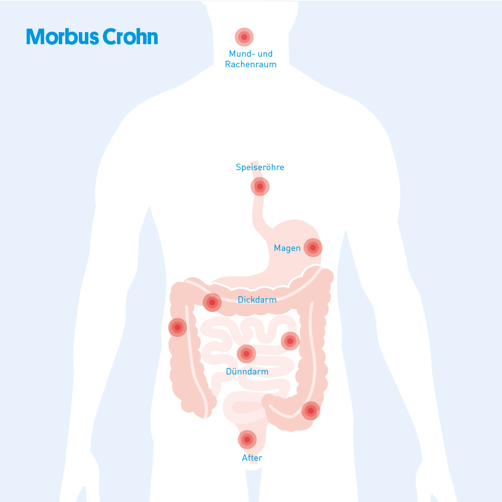 Der Magen-Darmtrakt und der hÃ¤ufig segmentale Befall bei Morbus Crohn: Gesunde Bereiche wechseln sich mit erkrankten ab. Eine typische Stelle ist der Ãbergang vom DÃ¼nn- zum Dickdarm betroffen.