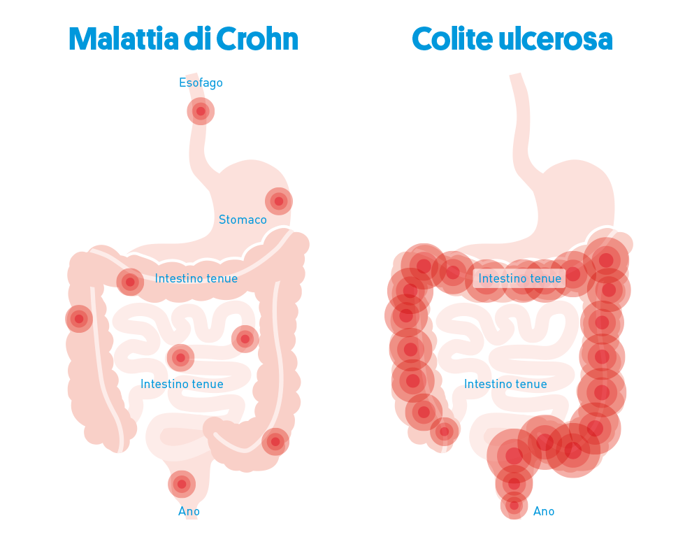 I possibili modelli di distribuzione dell'infestazione della malattia nel tratto gastrointestinale nella malattia di Crohn e nella colite ulcerosa