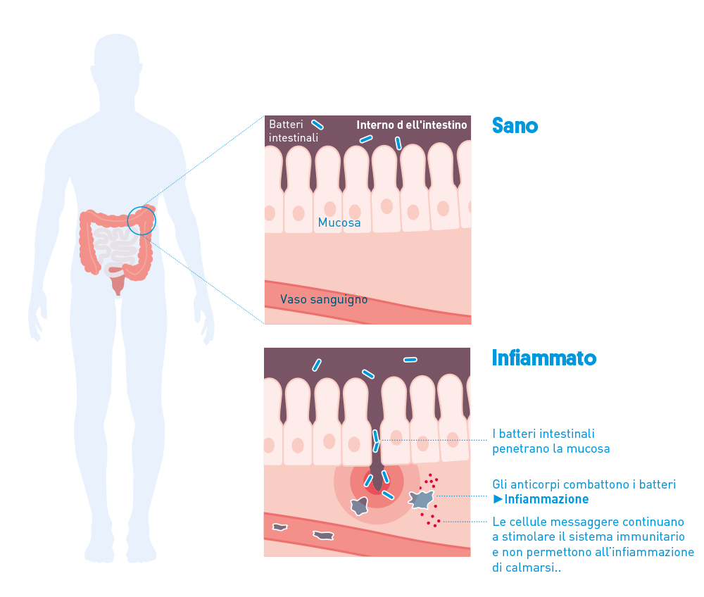 Nella malattia di Crohn, l'infiammazione colpisce tutti gli strati della parete intestinale.