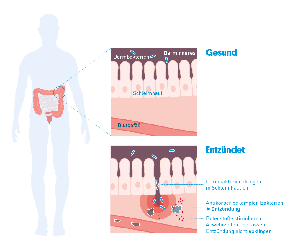 Bei Colitis ulcerosa ist eine chronische EntzÃ¼ndung des Dickdarms. Die EntzÃ¼ndung ist, anders als beim Morbus Crohn, auf die Schleimhautschichten des Darms beschrÃ¤nkt.