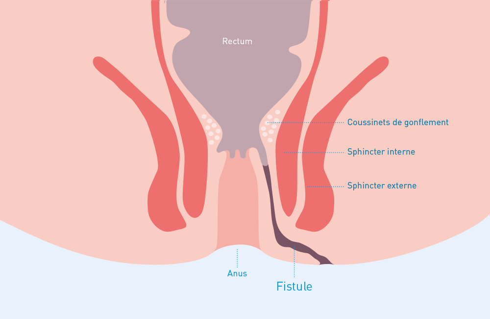 fistule péri-anale