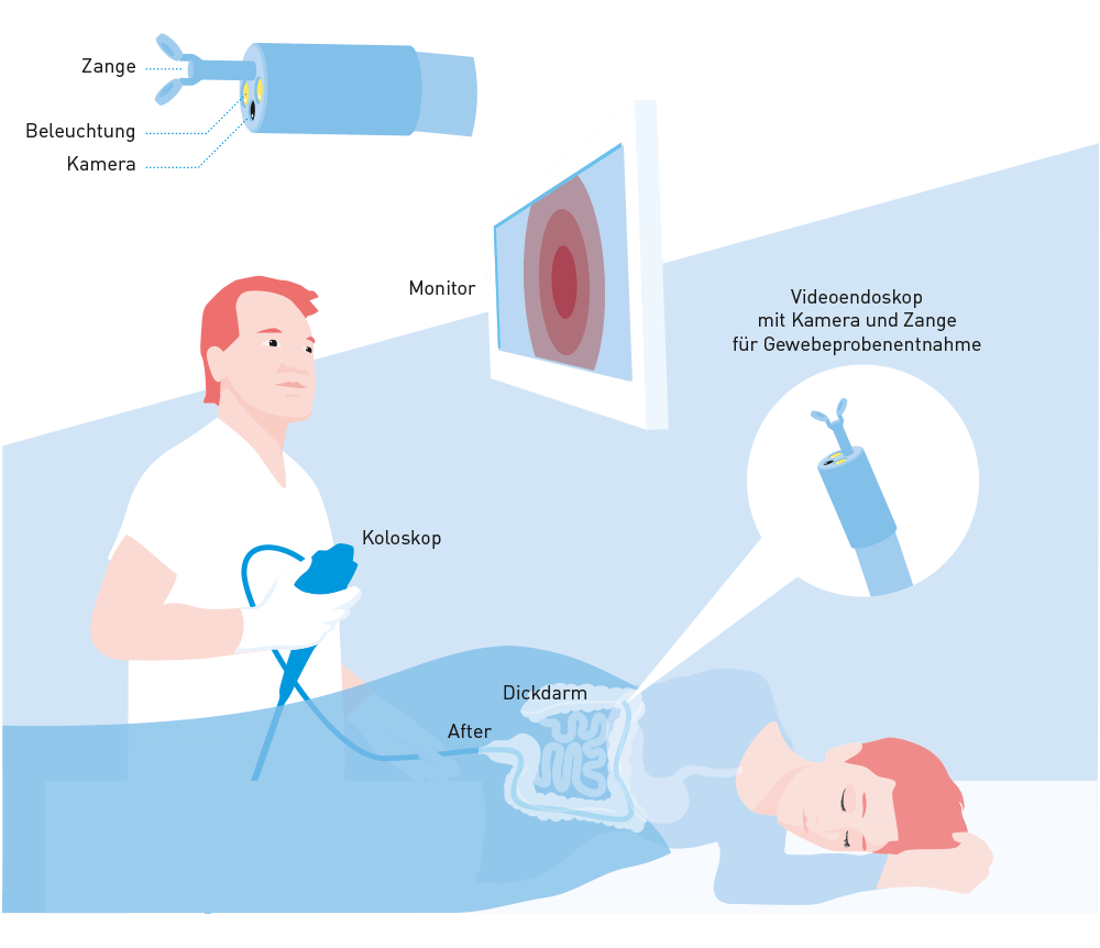 Beim ZurÃ¼ckziehen des Endoskops sieht sich der Gastroenterologe die Darmschleimhaut auf dem Monitor genau an.